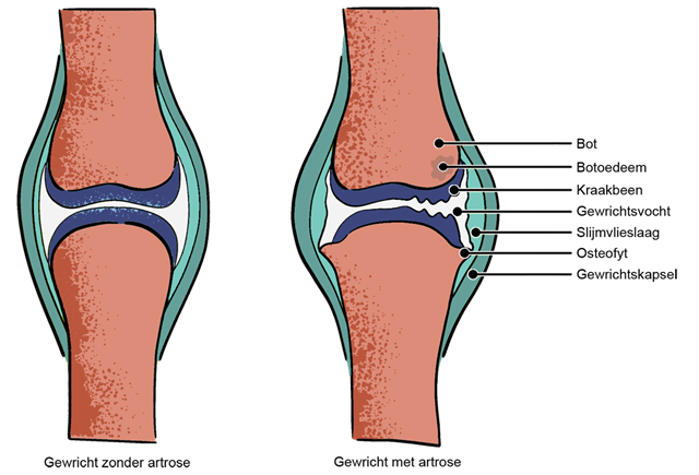 illustratie van knie-gewricht met en zonder artrose.