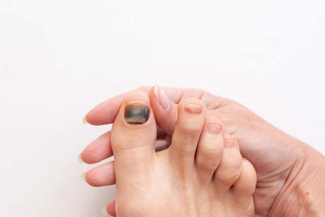 afbeelding van een blauwe teennagel.