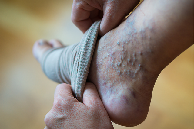 Compressiekousen, Hoe Werken Ze Hoe Werken Compressiekousen