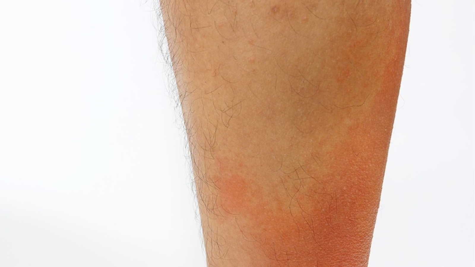 Rode Vlekken Op Je Benen Tijdens Het Wandelen