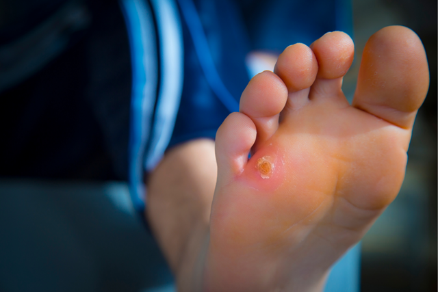Zo Voorkom Je Pijn Aan Je Voeten Tijdens Het Wandelen 3. Eeltknobbels (Bunion)