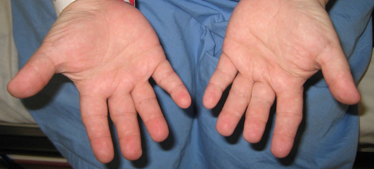 Header | Dikke vingers tijdens het wandelen (1)