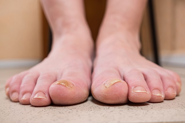afbeelding van voeten met een schimmelinfectie aan de tenen.