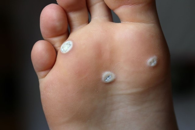 Help Ik Schaam Me Voor Mijn Voeten: wratten voet