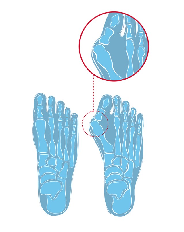 Illustratie van de anatomie bij Hallux Valgus.