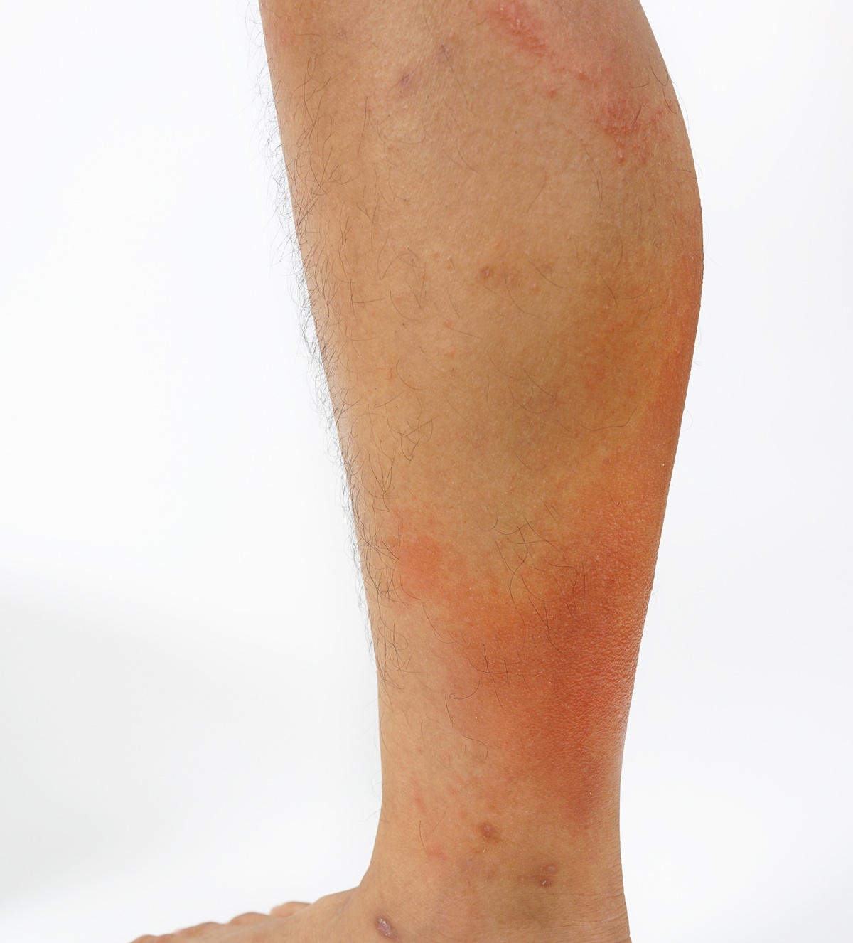 Rode vlekken op de huid tijdens het wandelen - Wandel