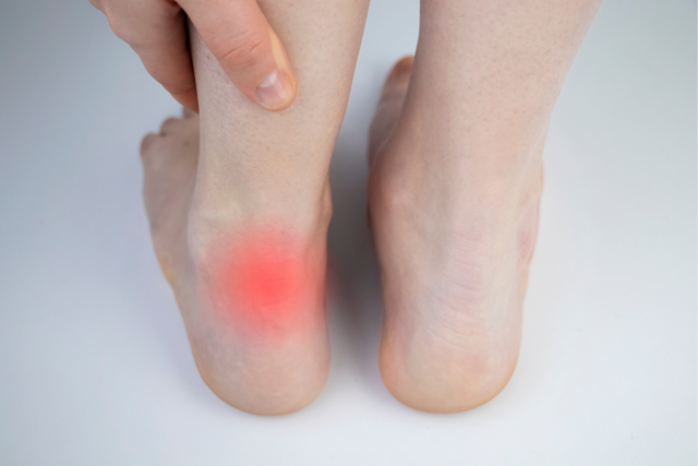 Zo Voorkom Je Pijn Aan Je Voeten Tijdens Het Wandelen 4. Achillespeesblessure