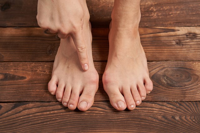 afbeelding van iemand met Hallux Valgus.