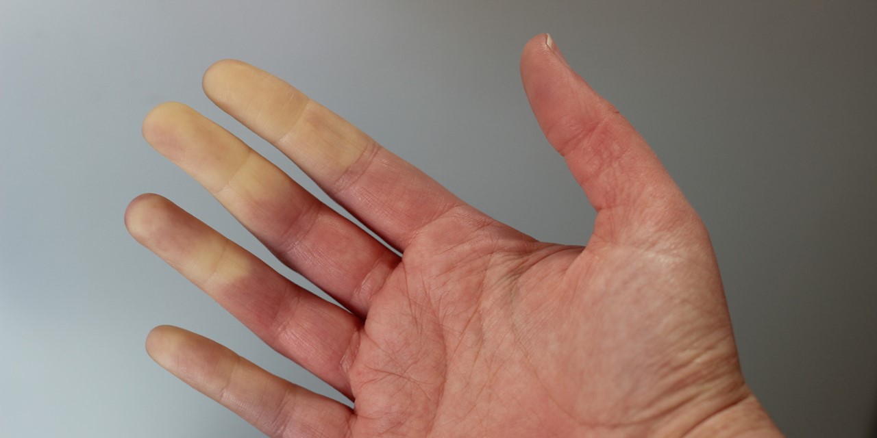 een hand met een slechte doorbloeding.