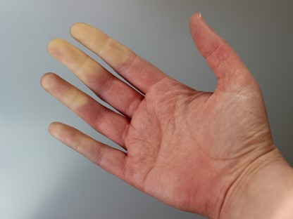een hand met een slechte doorbloeding.